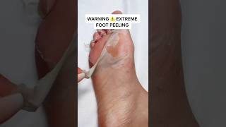 Extreme Foot Peeling  How To Get Rid of Callused amp Cracked Feet  Foot Peel Mask  Effectiveamp Fast [upl. by Yci]