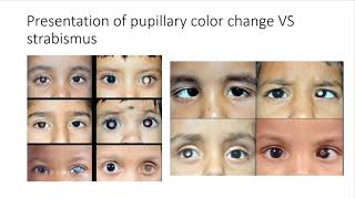 Retinoblastoma for medical students [upl. by Enicnarf924]