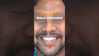 Digital Smile Designing in Single Visit  Before amp After  Mohan Dental Clinic hyderabad [upl. by Dimitris584]