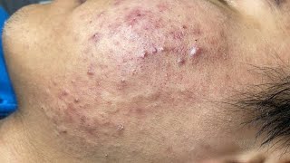 ACNE TREATMENT VU QUYNH MI  Blackheads Of Tweens 2024 EX [upl. by Eceinal]