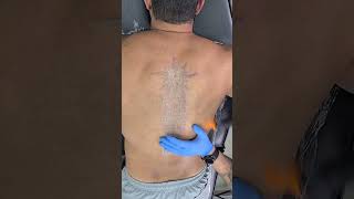 Remoção de tatuagem nas costas  Remoção de Tatuagem [upl. by Rubliw]