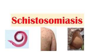 Schistosomiasis  Bilharziasis  Causes Symptoms and Treatment [upl. by Yesima850]