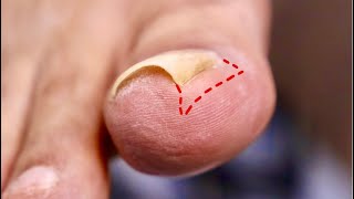 How Deep is this SUPER CURLED INGROWN NAIL [upl. by Freeborn]