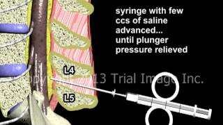 Epidural Spinal Anesthesia  Animation by Dr Cal Shipley MD [upl. by Vange]