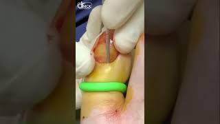 How to Treat a Toenail Infection 🤯😳 shorts [upl. by Dnomyad]