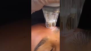 Potenza RF Microneedling at SEV Laser Chicago [upl. by Nnylrahc]