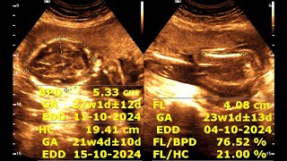 Routine antenatal ultrasound at 21 weeks gestation  Ultrasonography of a 21week pregnancy [upl. by Oizirbaf670]