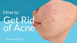 Acne Treatment  Explained by Dermatologist [upl. by Dygal]