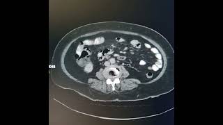 Appendicular abscess [upl. by Ardnasac]