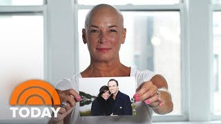 Women Reveal What Its Like To Experience Permanent Hair Loss  TODAY [upl. by Cailly288]