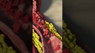 Heart Blockage💥 Angioplasty Explained in 30 Seconds ⏰quot [upl. by Lienaj]