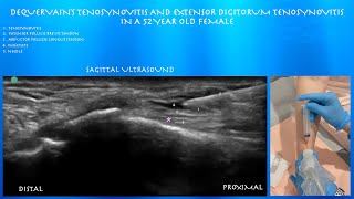 Ultrasound Guided Injection for De Quervains Tenosynovitis [upl. by Ahtiuqal85]