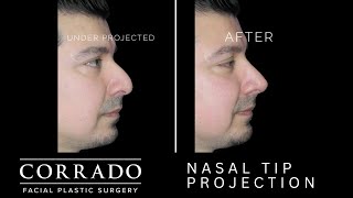 The Effect of Nasal Tip Projection Rhinoplasty Surgery [upl. by Dyan]