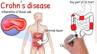 Crohns disease made simply Causes symptoms treatment [upl. by Eatton]