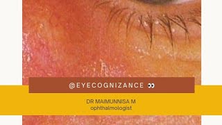 What is Dacryocystitis eyecognizance [upl. by Caryn]