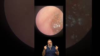 I Cant Hear From Using Ear Plug Deep Ear Wax  EP1005 [upl. by Vernon]