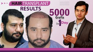 5000 Grafts Hair Transplant Results in India Before and After  Medispa India  Dr Suneet Soni [upl. by Hailee339]