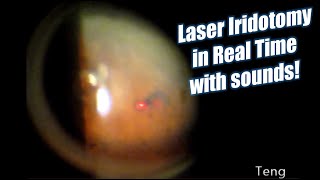 Laser Iridotomy in Real Time with Laser Sounds Chris Teng MD [upl. by Daile]