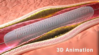 Balloon Angioplasty Procedure  3D Animation [upl. by Anivahs320]