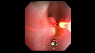 Posterior Glottic Stenosis using UPD with Fiber Dr Fink [upl. by Amati]