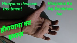 Hirayama desease Hindi part 2  hirayama desease ka Ilaj kya hai [upl. by Suraved470]