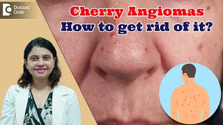 RED DOTS ON SKIN  Cherry Angioma amp its Treatment  Red Moles  Dr Amee Daxini  Doctors Circle [upl. by Alrahs]