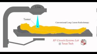 Conventional Radiotherapy [upl. by Ardnot]