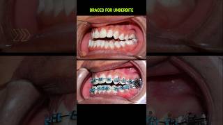 Underbite braces transformation braces orthodontist niengrang dentist [upl. by Holofernes507]