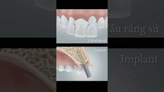 Dental bridge Vs Implant dental [upl. by Garap]