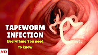 Tapeworm Infection – Causes Signs and Symptoms Diagnosis amp Treatment [upl. by Yank989]