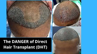 Disadvantages of Direct Hair Transplant DHT Dr As Clinic [upl. by Abbotsun]