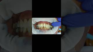 40 micron clearance and 80 micron resistance test for bilateral first molar implant crown GCam [upl. by Dall103]