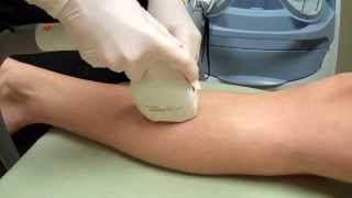 LightSheer Duet Laser Hair Removal on a Womans Legs [upl. by Kone]