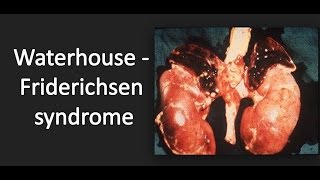 WaterhouseFriderichsen syndrome WFS [upl. by Radborne352]