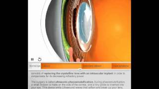 Cataract by Quantel Medical [upl. by Ttik]