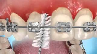 Comment se brosser les dents avec un appareil dentaire [upl. by Atiuqrahc]