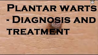 Plantar warts  Diagnosis and treatment [upl. by Sivert309]