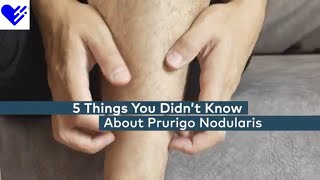 5 Things You Didn’t Know About Prurigo Nodularis  Healthgrades [upl. by Yrakcaz]