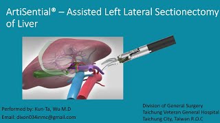 Artisential  assisted Left Lateral Sectionectomy [upl. by Erskine]