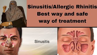 sinusitis treatment medicine for allergic RhinitisNostrits pain treatment [upl. by Torres]