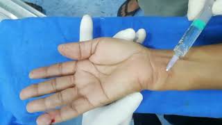 Ulnar Nerve block at Wrist Painless Little Finger RepairFinger splint [upl. by Pussej571]