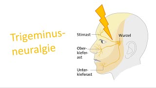 Trigeminusneuralgie [upl. by Brill833]