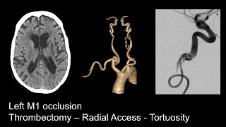 Stroke  Left M1 occlusion Radial  Tortuous 1x [upl. by Ellie]