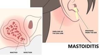 MastoiditisIntroduction of mastoiditis  Definition of mastoiditis Classification of mastoiditis [upl. by Neerehs]