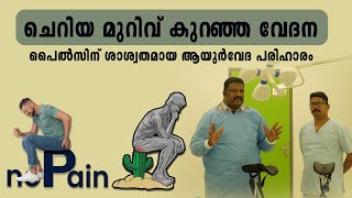 ചെറിയ മുറിവ് കുറഞ്ഞ വേദന പൈൽസിന് ശാശ്വതമായ ആയുർവേദ പരിഹാരം  Treatment for Piles [upl. by Ecneralc700]