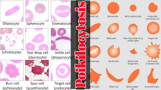 Blood Smear Examination POILKILOCYTOSIS blood smear Lecture 4 [upl. by Endor]