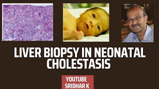 Liver biopsy to diagnose biliary atresia liverbiopsy histopathology biliaryatresia [upl. by Russi336]