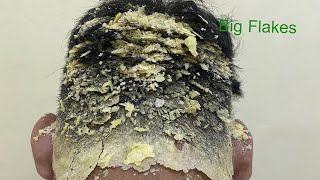 DRY SCALP  Big Flakes Dandruff Scratching Satisfying Video 768 [upl. by Enybor841]