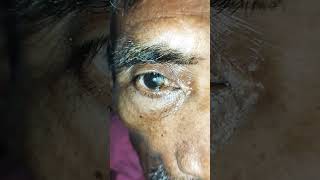 Pterygium with cataract eye eyecareeye disease eyeophthalmology [upl. by Eadmund]