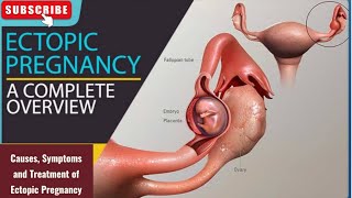 Ectopic Pregnancy Understanding the Risks Symptoms and Treatment [upl. by Htiekel]